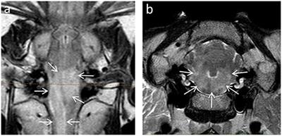 Correlative Magnetic Resonance Imaging and Histopathology in Small Ruminant Listeria Rhombencephalitis